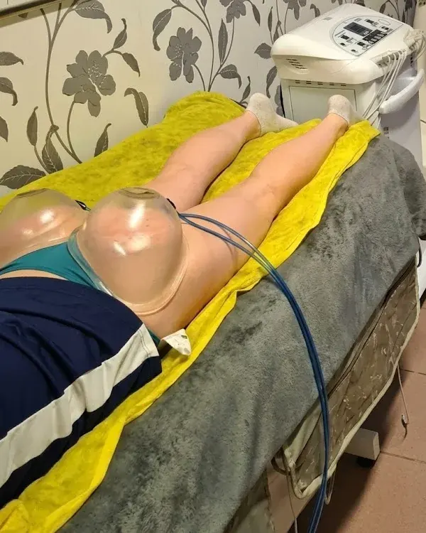 SPM vákuummasszázs kezelőfeje a combon